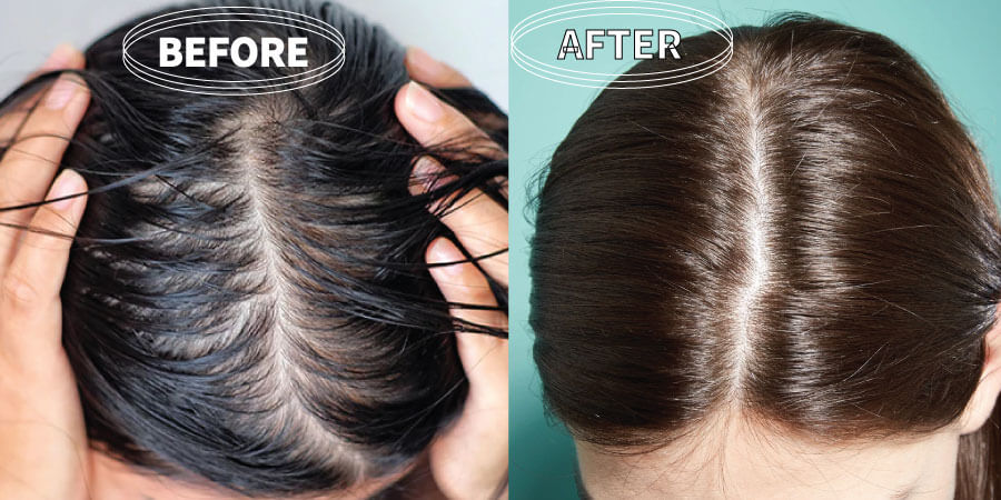 female hair loss before and after pictures