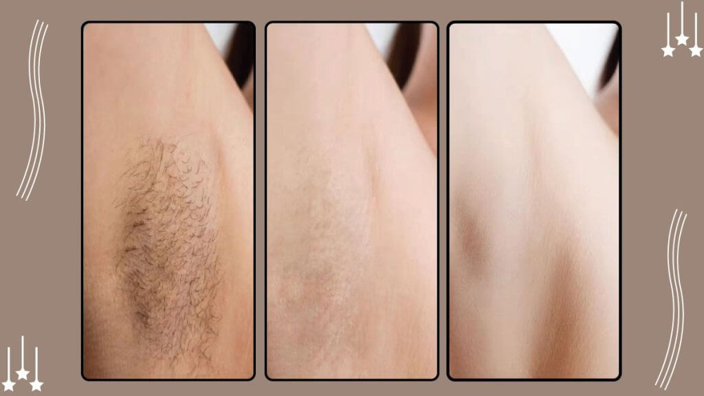 How Long After Laser Treatment Does Hair Fall Out